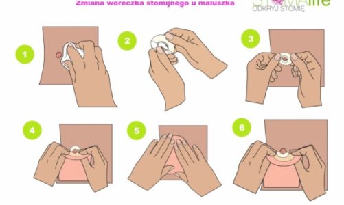 Pielęgnacja skóry maluszka ze stomią